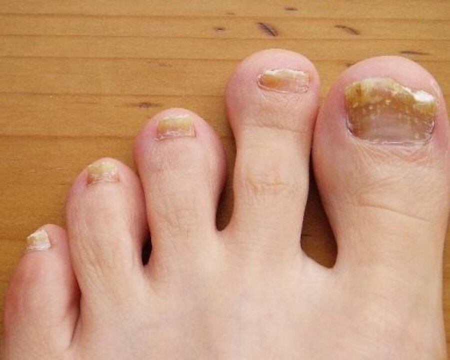 Yellowing of the nail plate due to fungus.