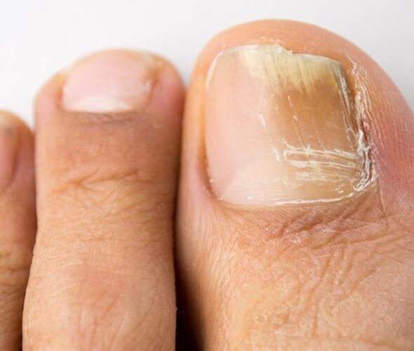 fungal infection of the toenails