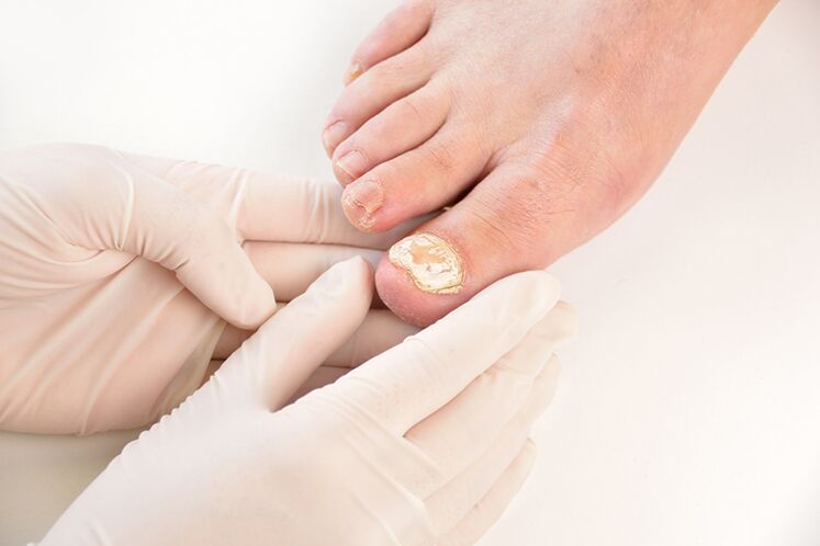 Before prescribing treatment, the doctor must diagnose the toenail fungus. 