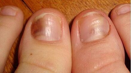 A sign of mycosis is the darkening of the nail plate. 