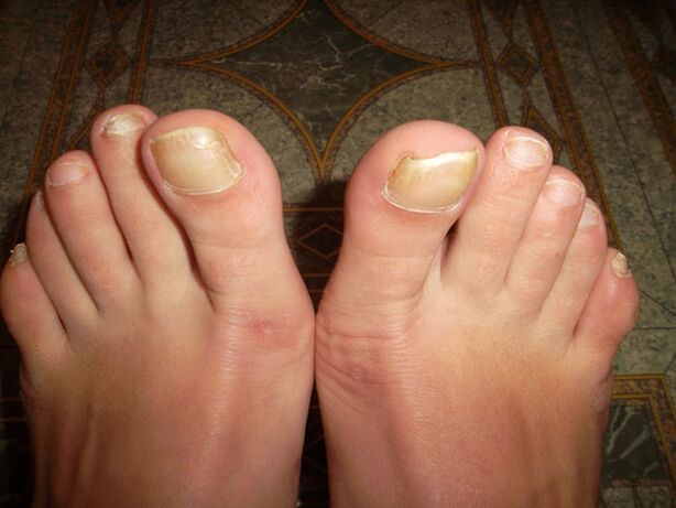 Thickening of the toenails with onychomycosis