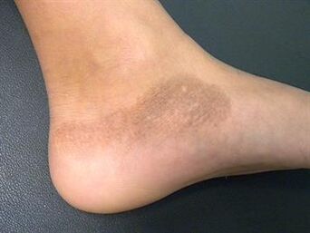 Mycosis of the feet is accompanied by a change in skin tone. 