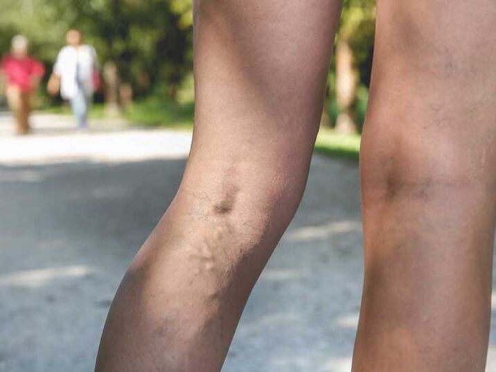 Varicose veins are a risk factor for foot fungal infection