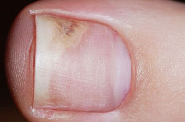 Signs of onychomycosis in the initial stage dullness, space between the nail and the bed