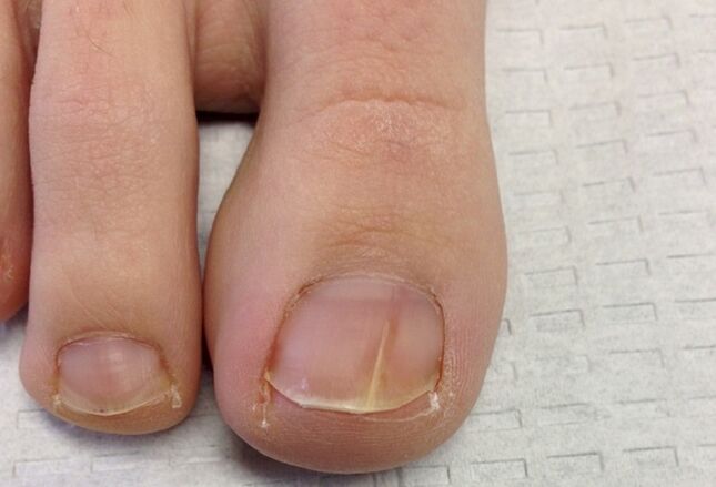 Visual manifestations of toenail fungus in the initial stage. 