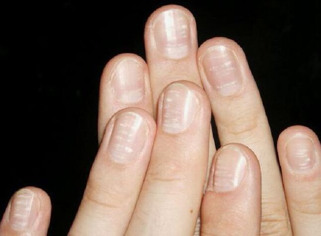 White spots on nails are a sign of fungal development