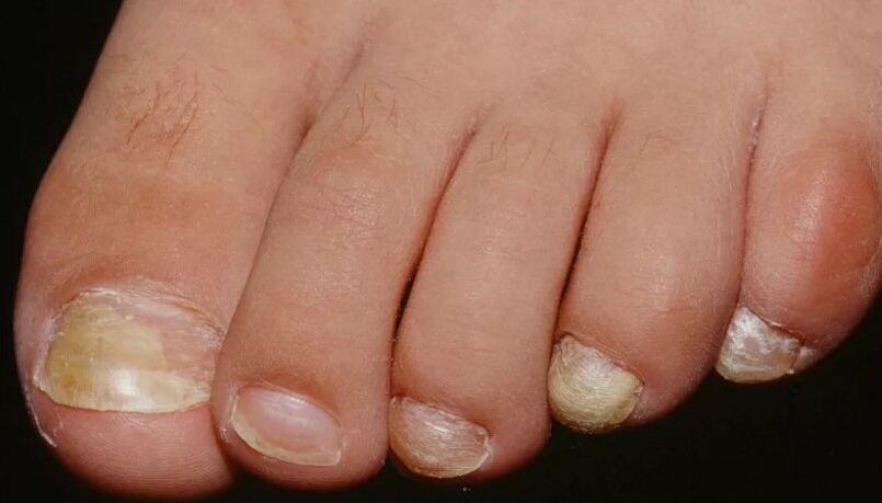 The fungus of the nail on the thumb