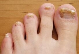 Onychomycosis run over