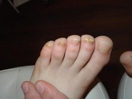The nail fungus occurs even in children