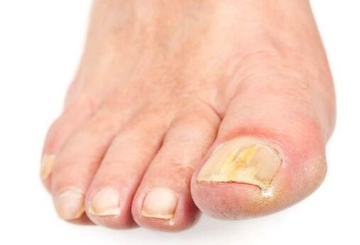 Nail fungus