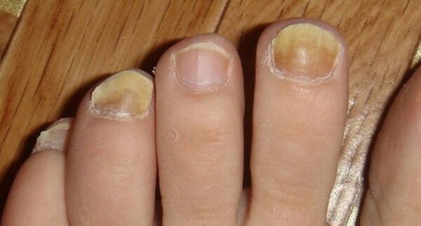 Change the color and nail structure