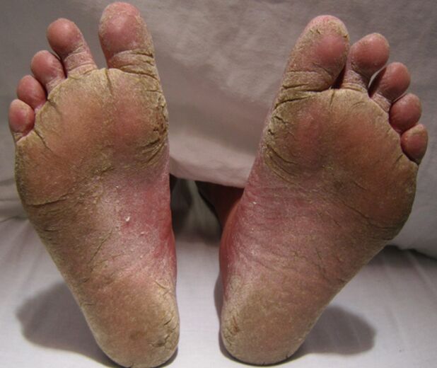 Micmous defeat of the feet