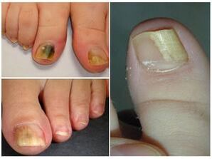 How do you see the fungus on the nails