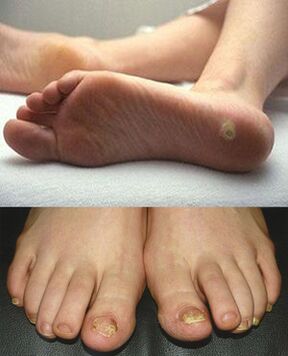 The fungus in the legs