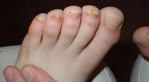 Almost all fingers are affected by the fungus