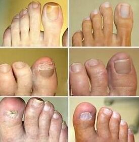 Nail deformation