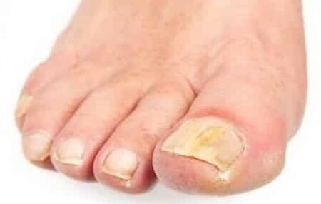 The initial stage of the fungus in the foot nail