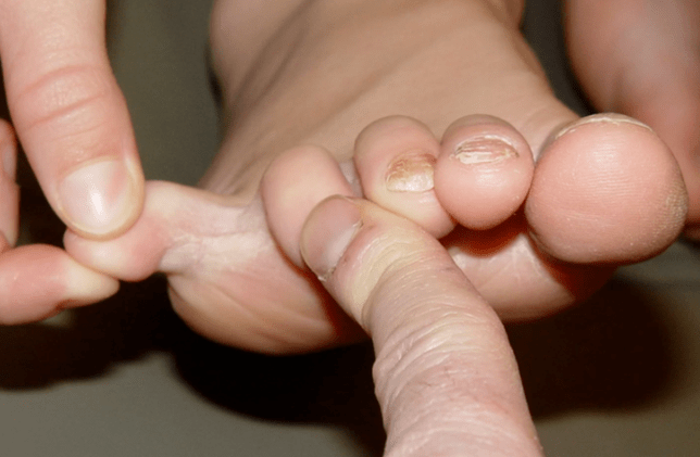 Fungus between the fingers
