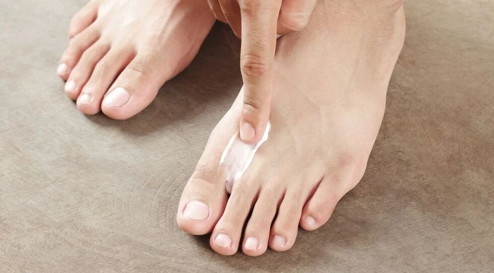 Apply the fungus cream between the fingers