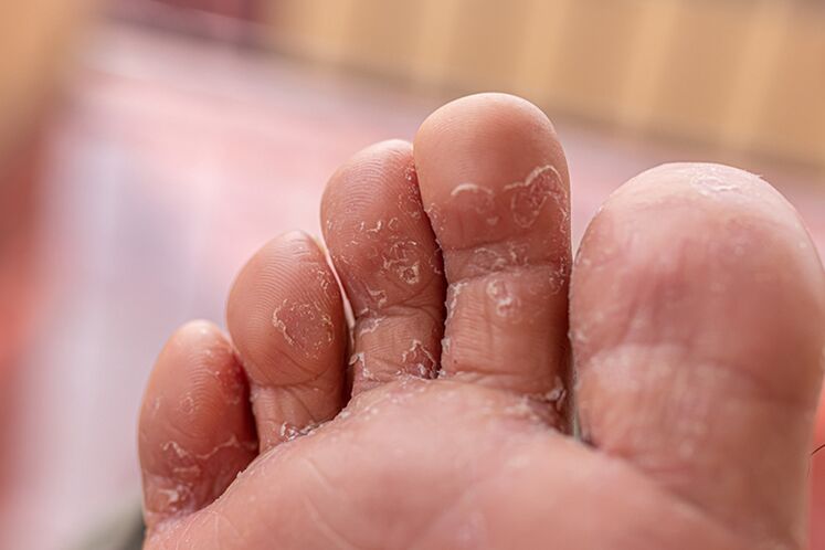 Fungus between the fingers