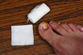 Compens with apple cider vinegar for fungi treatment