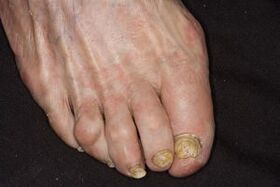 Treatment of nail fungus on apple cider vinegar vinegar