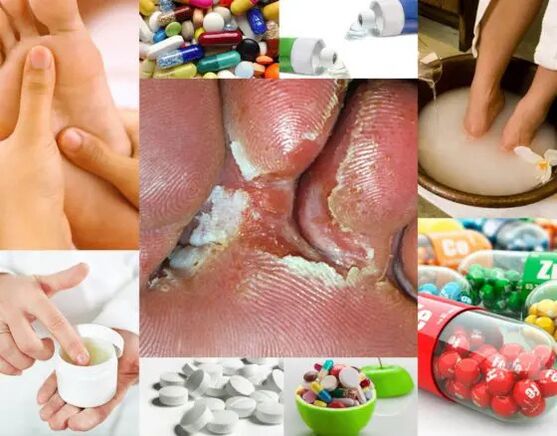 Interdigital mycosis and treatment methods.