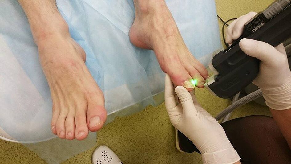 Laser therapy for nail fungus.