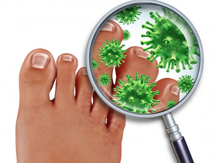 mycosis