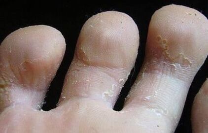 signs of fungus between the fingers