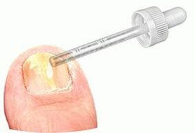 Apply medicated drops to a nail affected by fungus.
