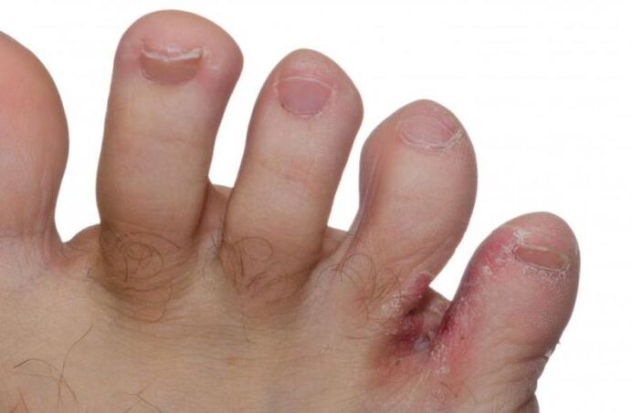 Foot fungus between the toes.