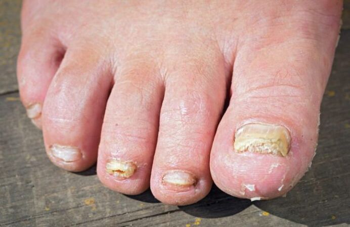 Rubromycosis fungus on the feet.