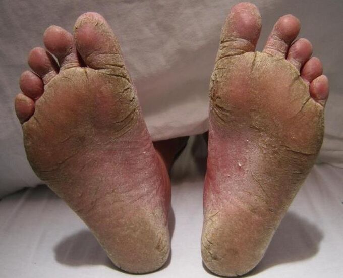 scaly-hyperkeratic fungus on the legs