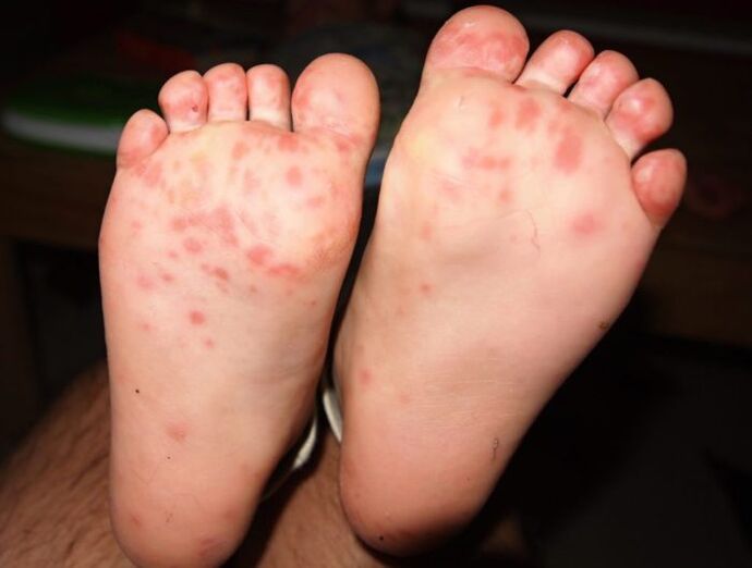 vesicular fungus on legs