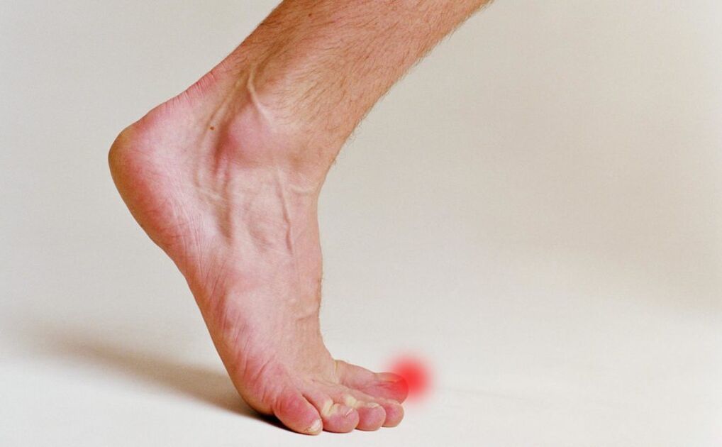 Big toe nail fungus