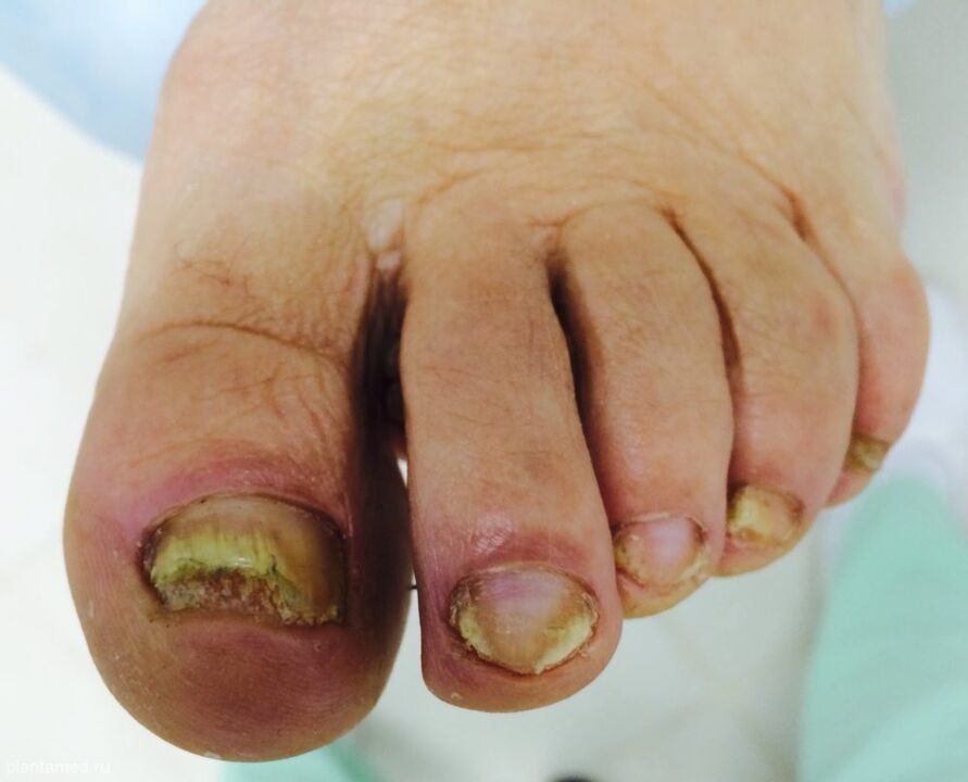 Severe deformation of the toenails is a sign of the advanced third stage of the fungus.