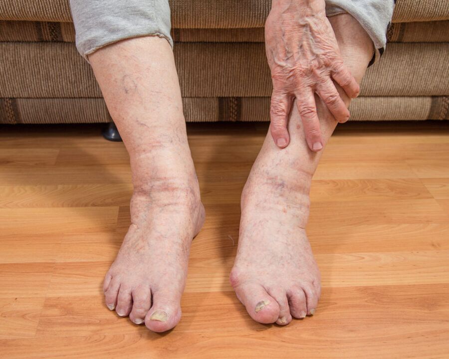 To prevent the spread of fungal microspores, do not walk around the house barefoot.