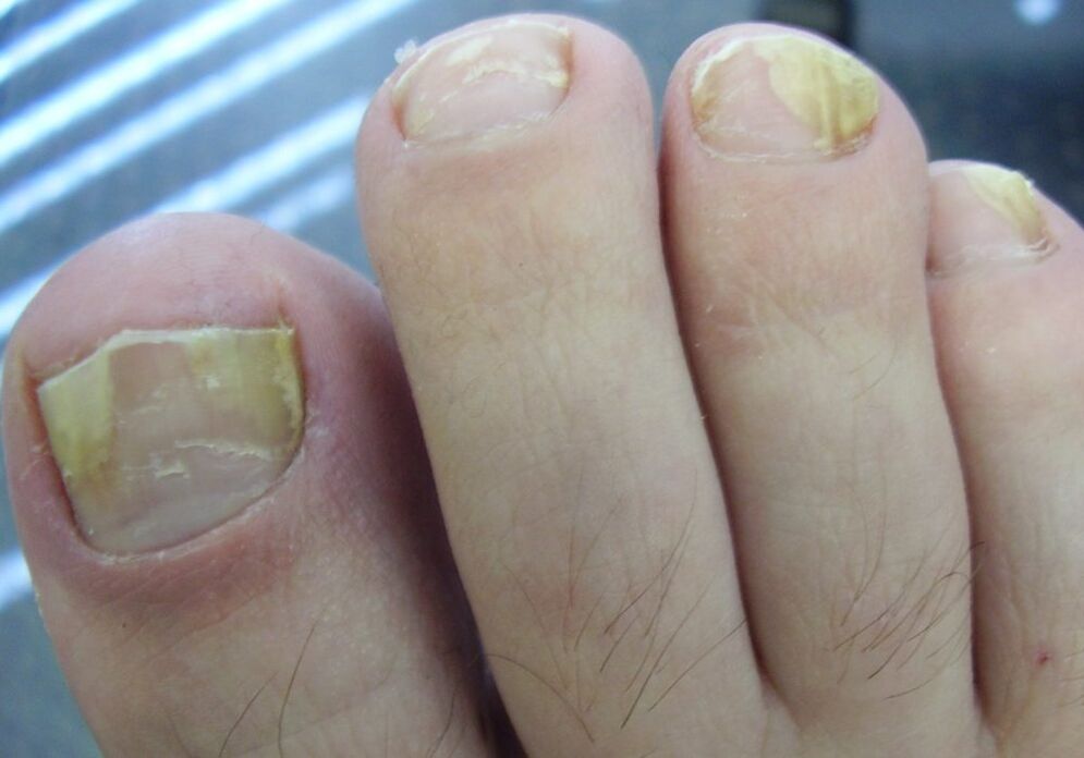 Yellow color of the nail plate in the second stage of fungal infection.
