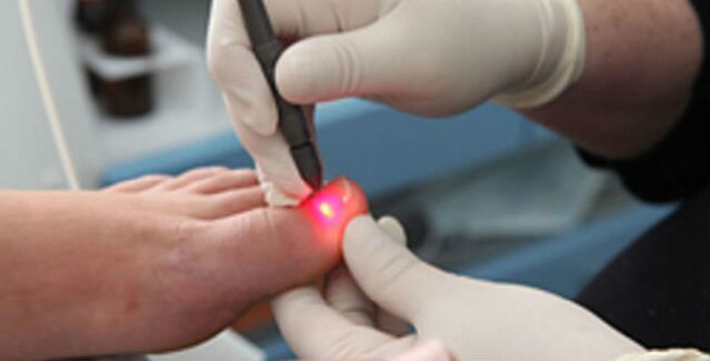 Laser therapy for toenail fungus.