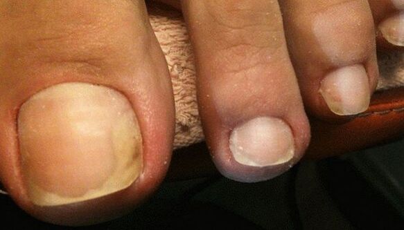 Signs of the initial stage of toenail fungus.